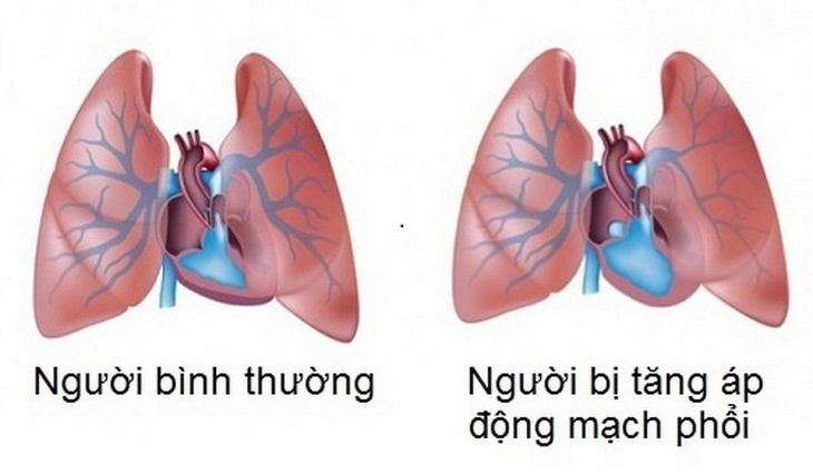 Nếu không được phát hiện và điều trị kịp thời, tăng áp động mạch phổi sẽ để lại những biến chứng nguy hiểm.